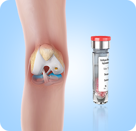 Matrix Induced Autologous Chondrocyte Implantation (MACI)