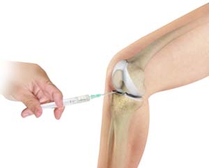 cortisone-injection-img