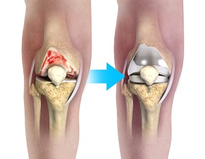Complex Total Knee Replacement pic