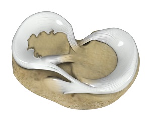 Degenerative Meniscal Tears pic