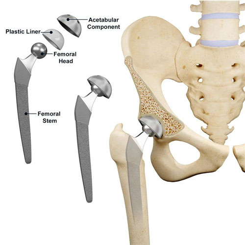 Hip Replacement pic