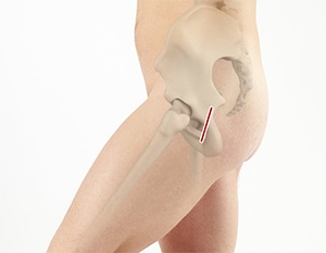 Mini-Posterior Hip Replacement pic