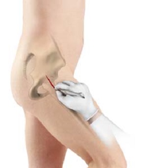 Minimally Invasive Muscle-Sparing Total Hip Replacement pic