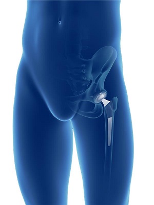 Primary Hip Replacement pic