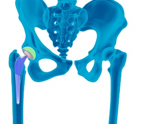 Robotic Anterior Total Hip Arthroplasty pic