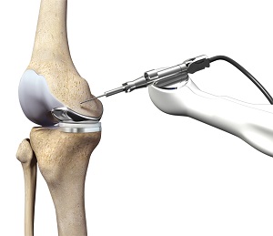 Robotic Unicondylar Knee Replacement pic