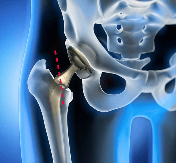 Img-Minimally Invasive Hip & knee Surgery