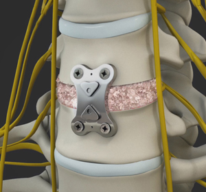 Anterior Cervical Discectomy with Fusion Images