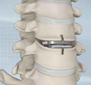 Artificial Cervical Disc Replacement Images