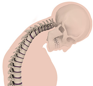 Cervical Deformities Images