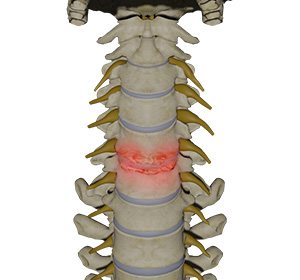 Cervical Degenerative Disc Disease Images