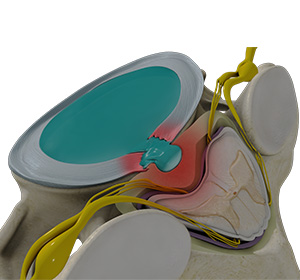 Cervical Disc Herniation Images