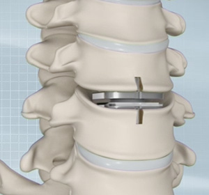 Cervical Disc Replacement Images