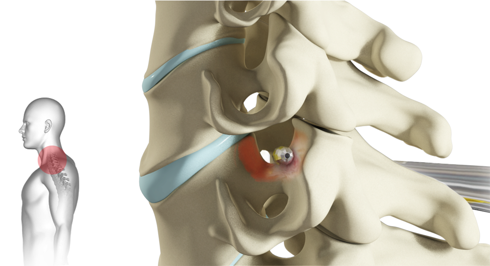 Cervical Foraminotomy Images