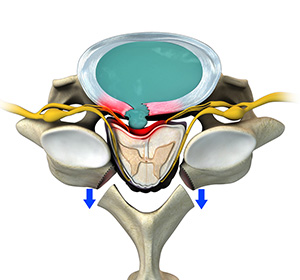 Cervical Laminectomy Images
