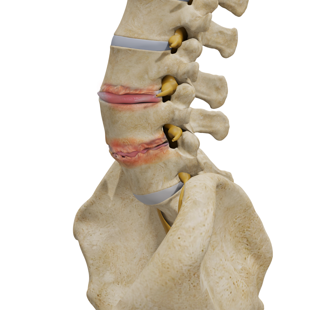 Degenerative Disc Disease Images