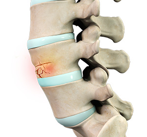 Fractures of the Spine Images