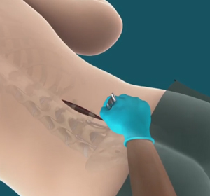 Lower Back (Lumbar) Surgery Images
