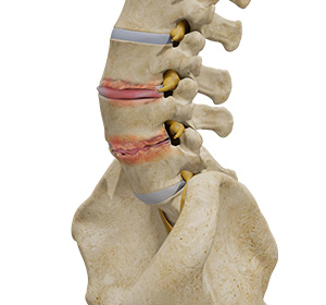 Lumbar Degenerative Disc Disease Images