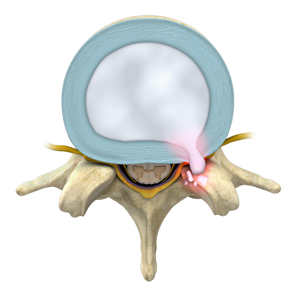 Lumbar Disc Herniation Images