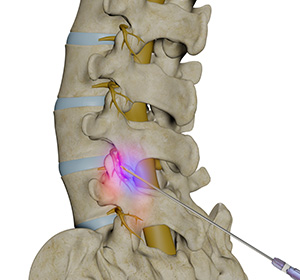 Lumbar Facet Joint Arthropathy Images