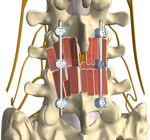 Lumbar Fusion Procedures Images