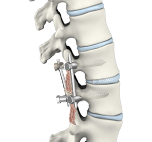 Lumbar Interbody Fusion Images