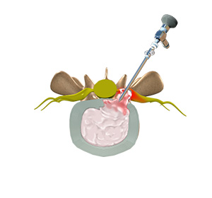 Lumbar Microdiscectomy Images