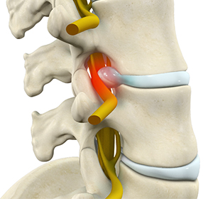Lumbar Radiculopathy Images