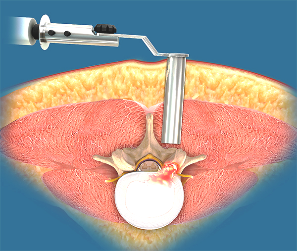 Minimally Invasive Lumbar Surgery Images