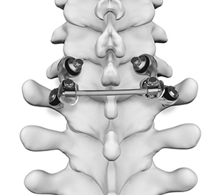 Motion Preservation Surgery Images