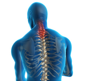 Neck Strains and Sprains Images