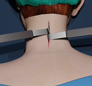 Neck Surgery Images