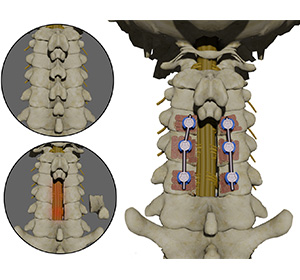 Posterior Cervical Decompression Images