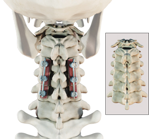 Posterior Cervical Fusion Images
