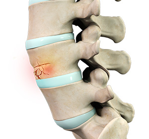 Spinal Compression Fractures Images