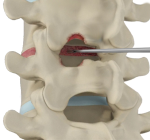 Spinal Decompression Images