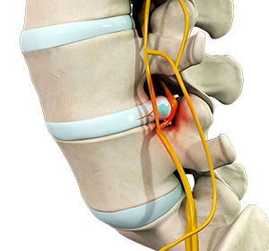 Spinal Disorders Images