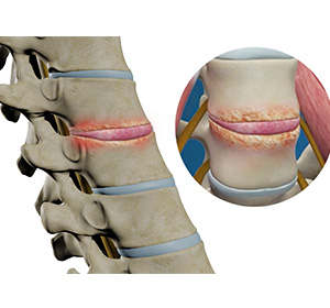 Spinal Infection Images