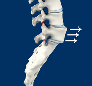 Spinal Instability Images