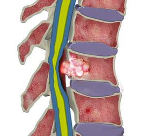 Spinal Tumors Images