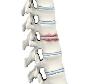 Spine Arthritis Images
