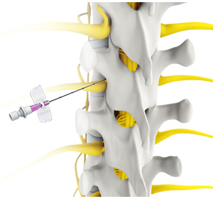 Spine Injections Images