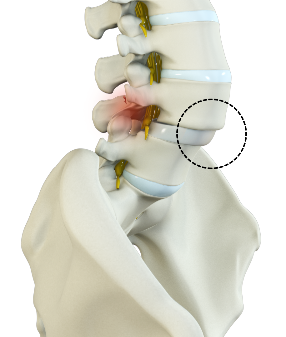 Spondylolisthesis Images