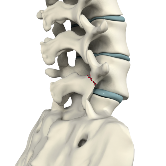 Spondylolysis Images