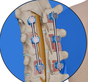 Thoracic Corpectomy Images