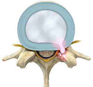 Thoracic Disc Herniation Images