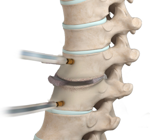 Thoracic Discectomy Images