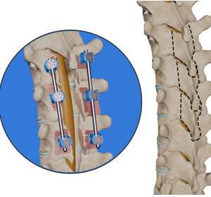Thoracic Laminectomy Images