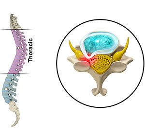 Thoracic Myelopathy Images